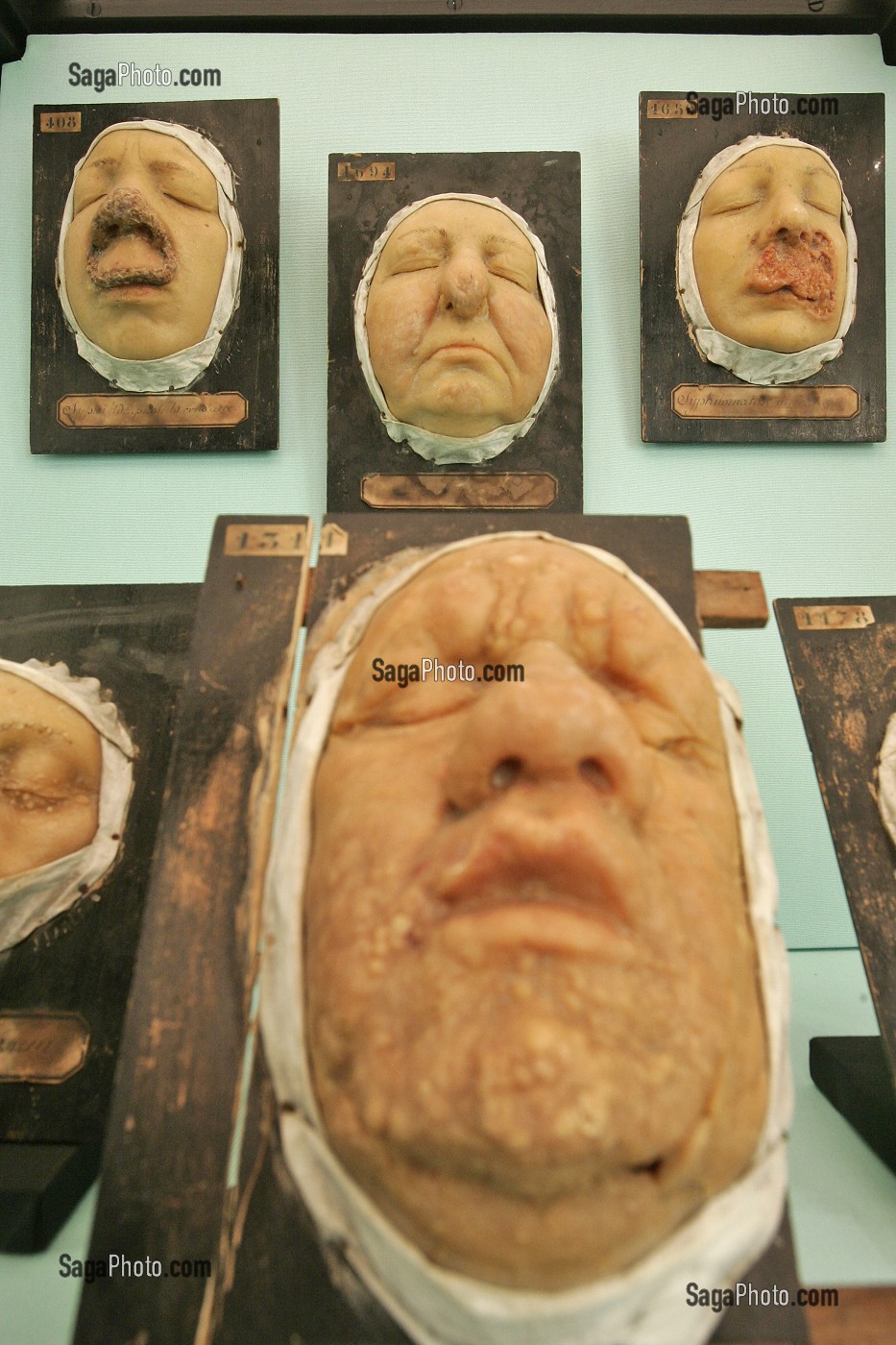 MALADIE DU VISAGE, MUSEE DE LA MEDECINE, HOTEL-DIEU, SAINT-CYPRIEN, TOULOUSE, HAUTE-GARONNE (31), FRANCE 